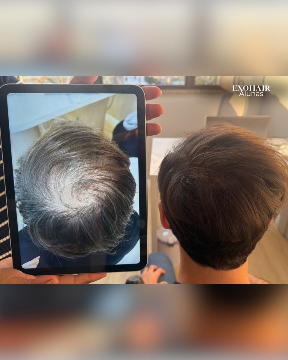 ExoHair, before and after