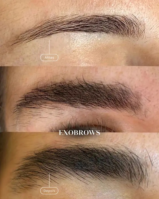 ExoBrows, before and after