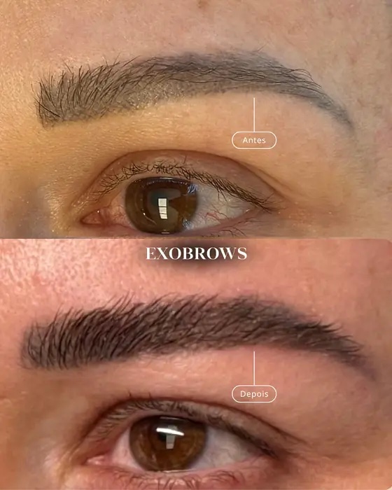 ExoBrows, before and after