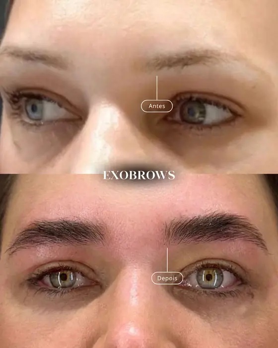ExoBrows, before and after