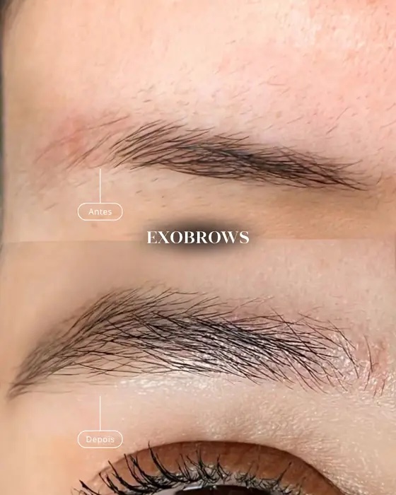 ExoBrows, before and after
