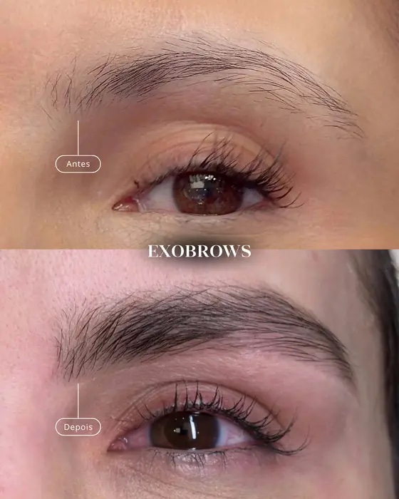 ExoBrows, before and after