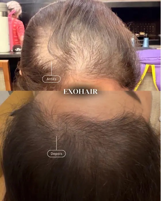 ExoHair, before and after