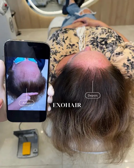 ExoHair, before and after