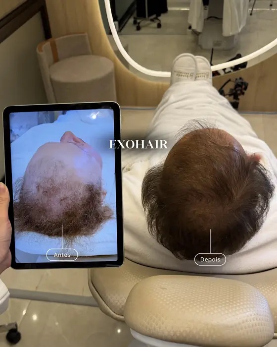 ExoHair, before and after