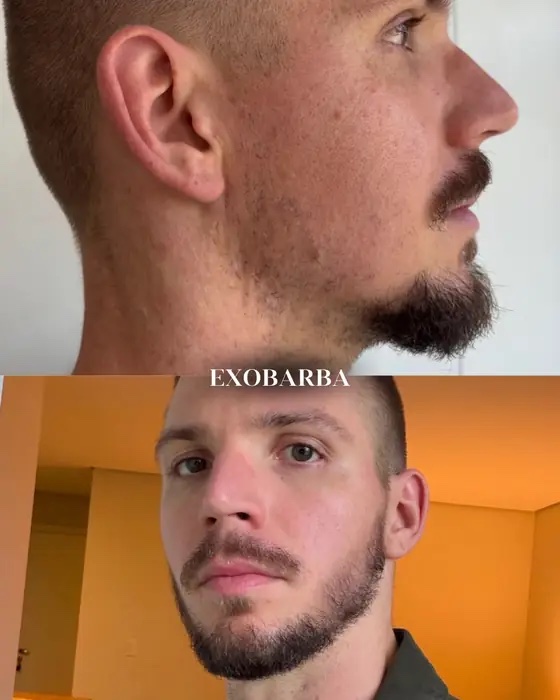 ExoBarba, before and after