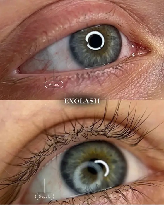 ExoLash, before and after