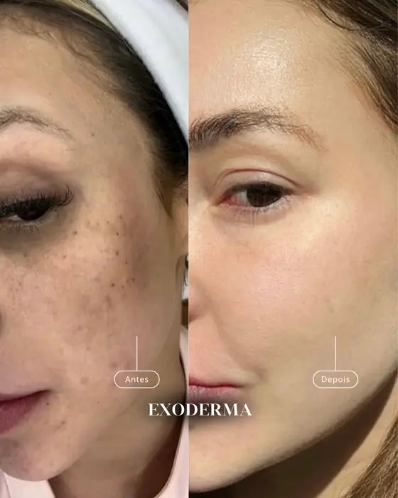 Exoderma, before and after