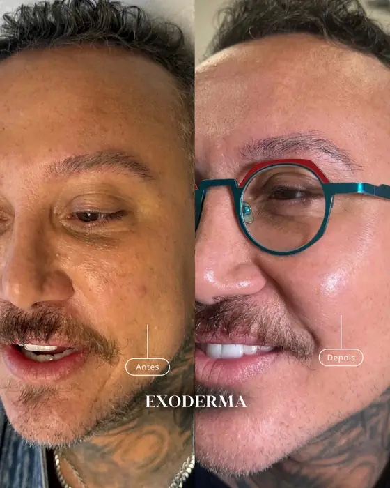 Exoderma, before and after